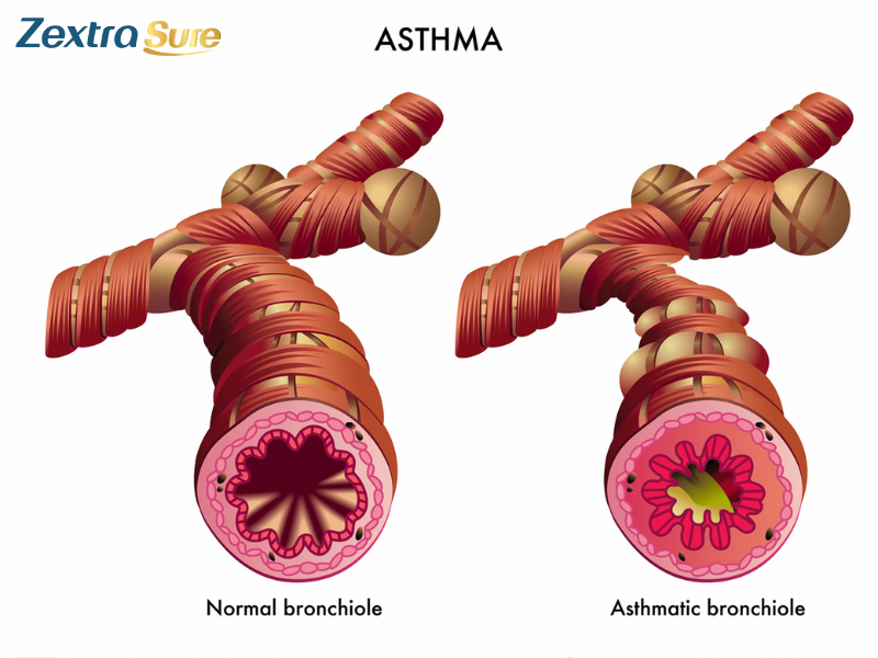 silent-asthma-attack-symptoms (2)